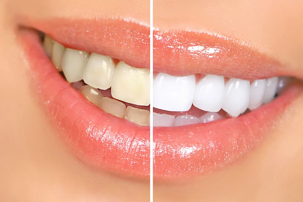 34519 best teeth whitening hilliard provider