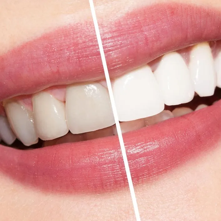 /img/34519-teeth-whitening-consultation-hilliard.webp