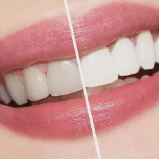 /img/34519-teeth-whitening-consultation-hilliard.webp