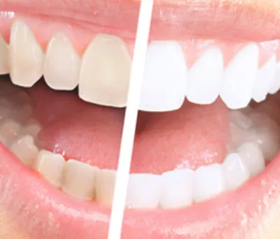 34519 teeth whitening procedure hilliard