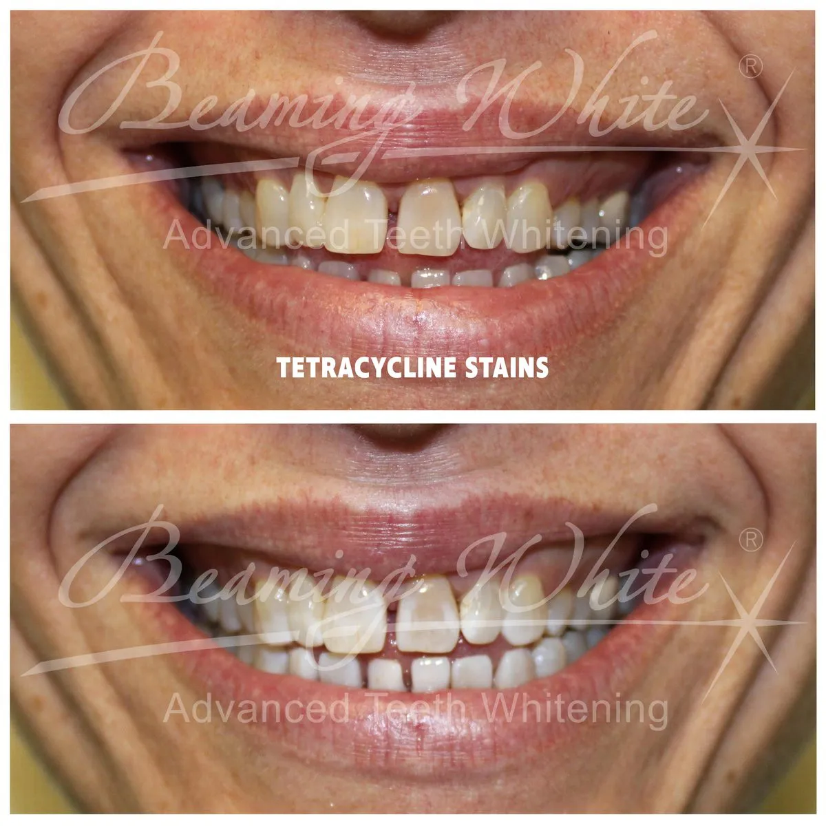 34527 at home teeth whitening kit