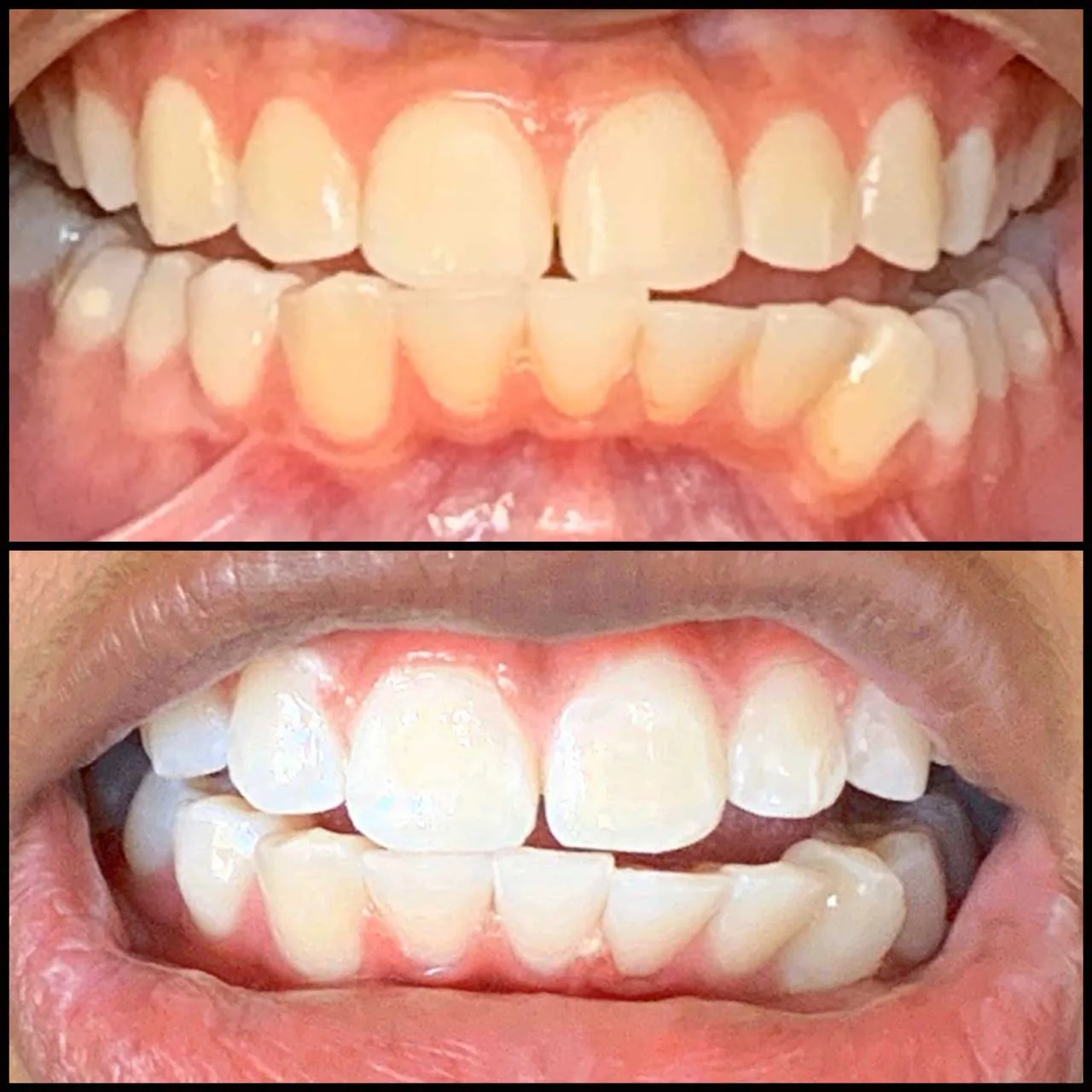 34533 teeth whitening redding ca custom trays