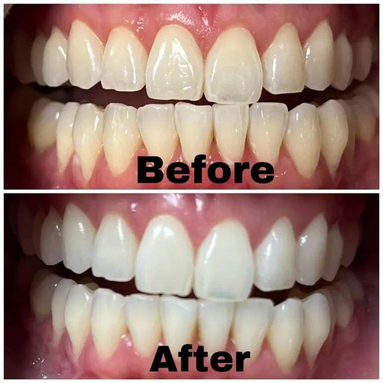 34533 teeth whitening redding ca in office