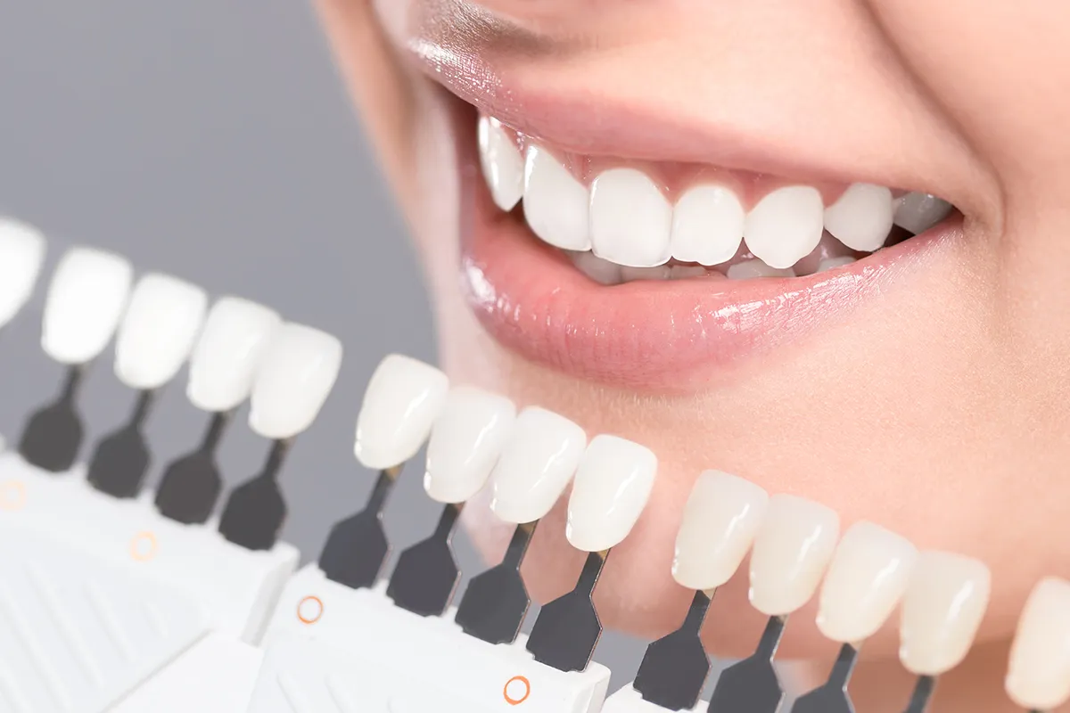 34534 teeth whitening options