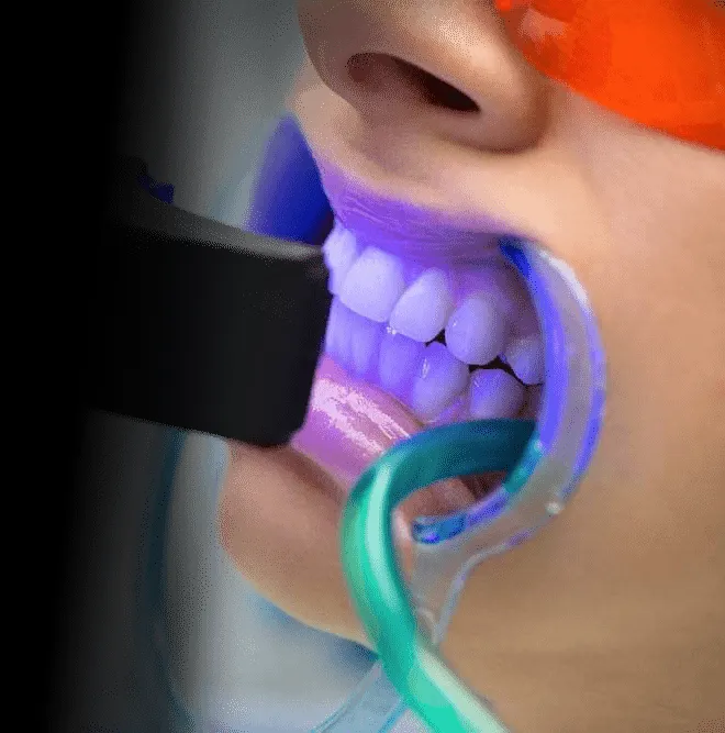 34534 teeth whitening packages