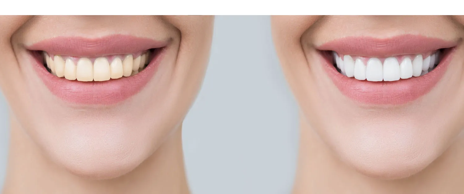 34546 teeth whitening park slope 1