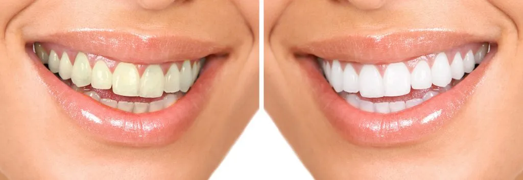 34546 teeth whitening park slope 6