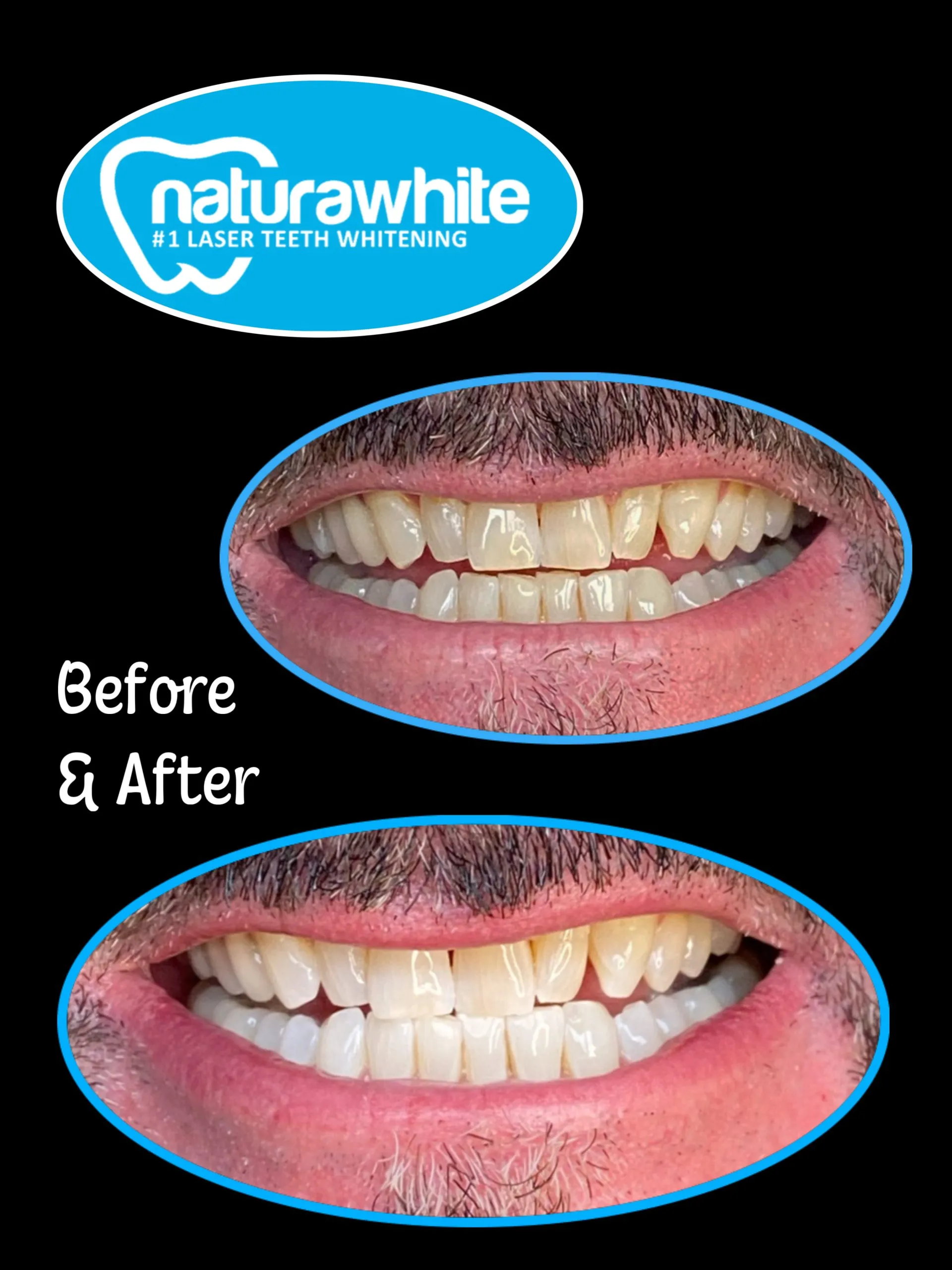 34548 laser teeth whitening atlanta dentist