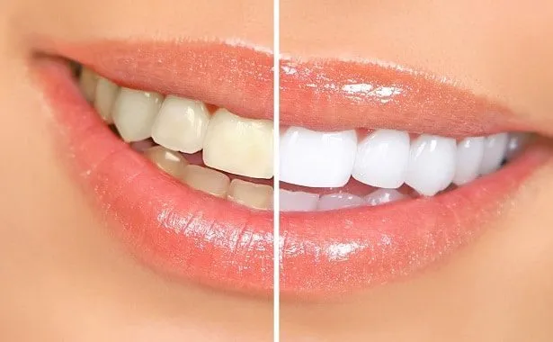 34556 teeth whitening maintenance