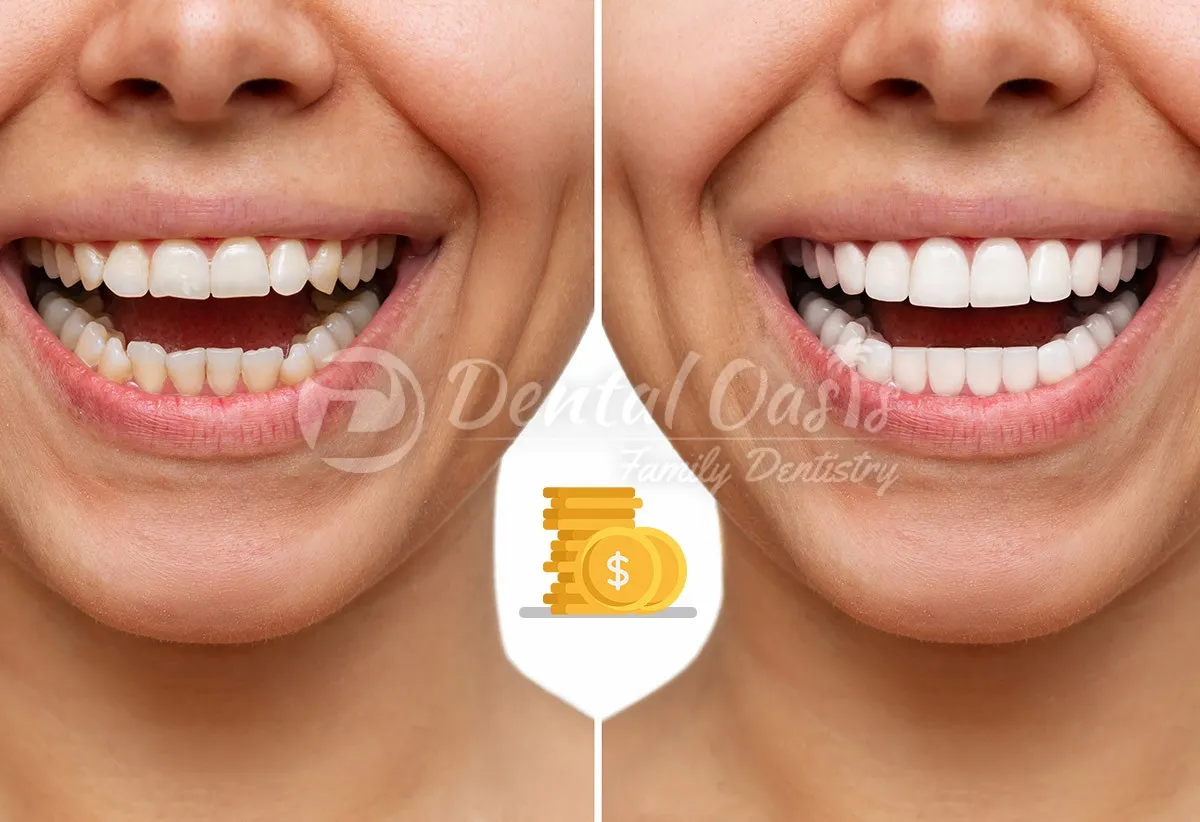 34556 veneers vs whitening