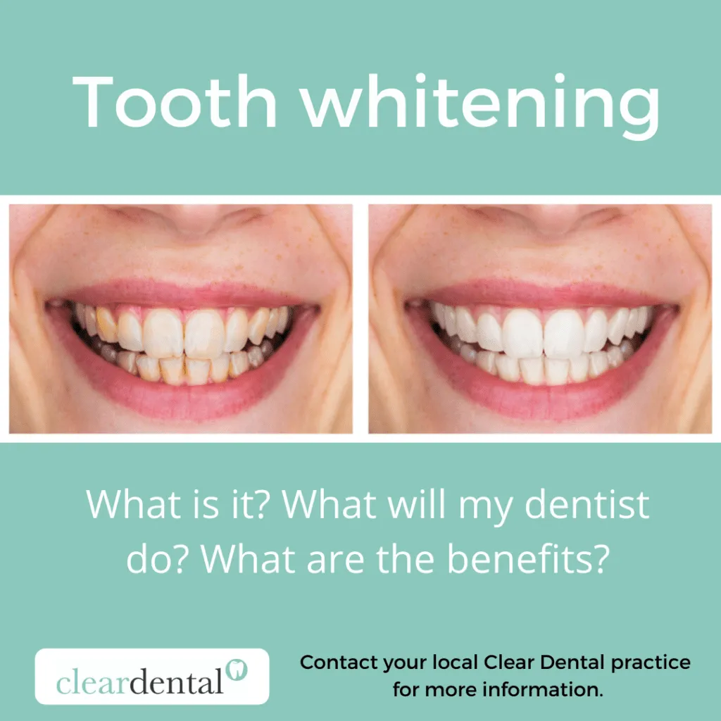 34561 at home teeth whitening kit