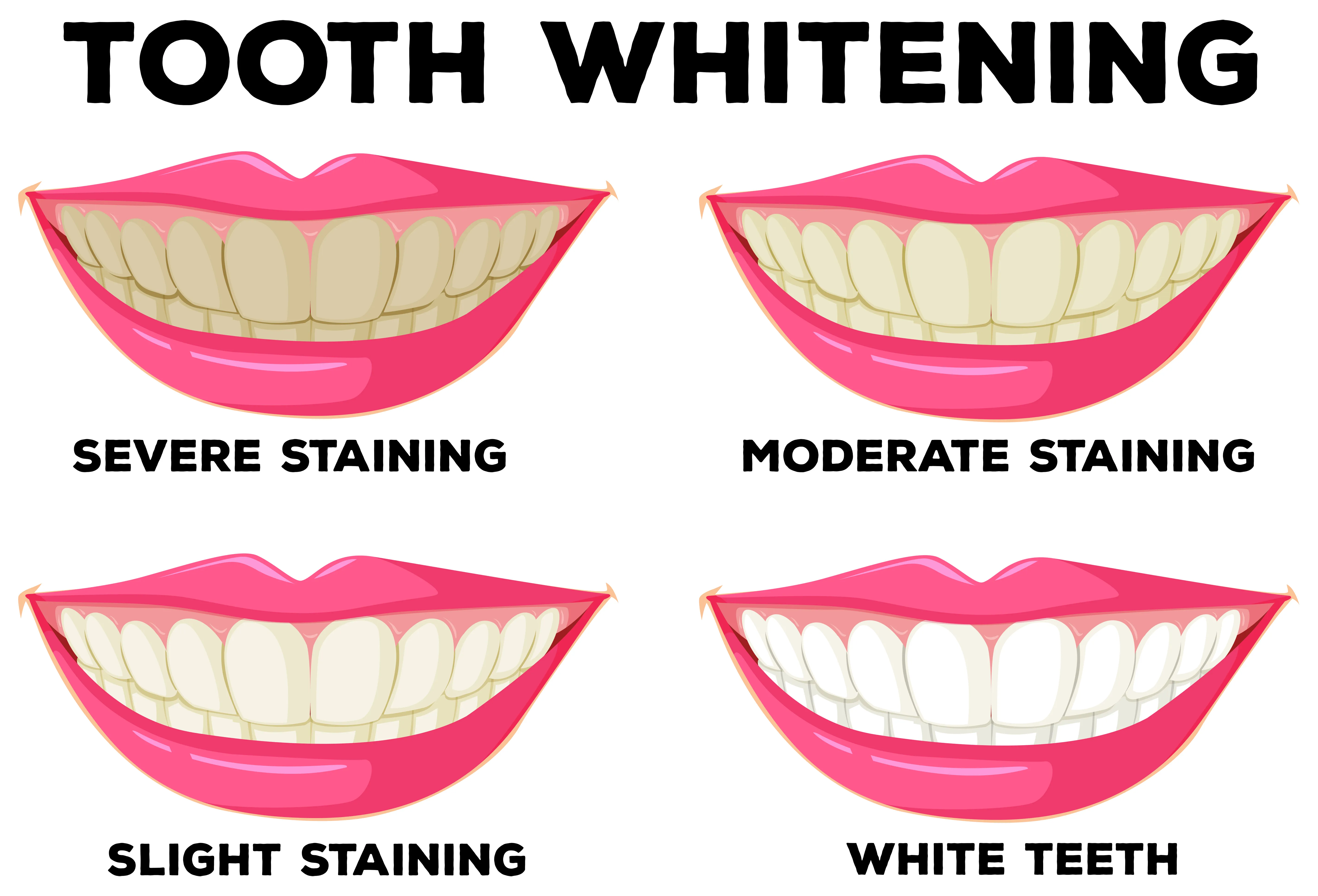 34561 professional teeth whitening
