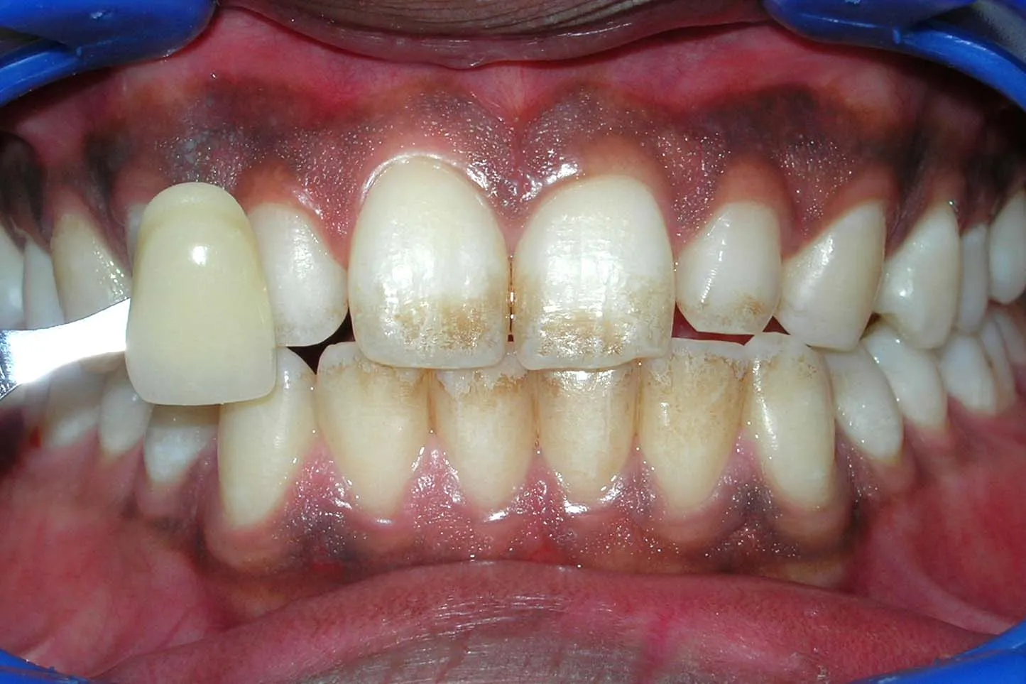 34600 brightening vs whitening 2