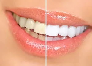 34602 at home teeth whitening