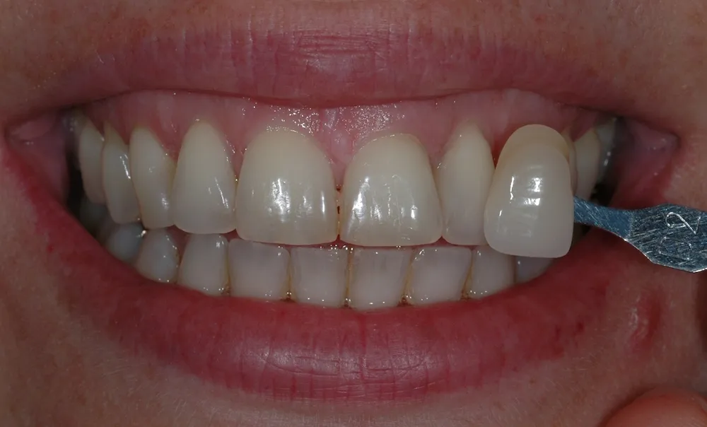 34617 tooth whitening cost oxford