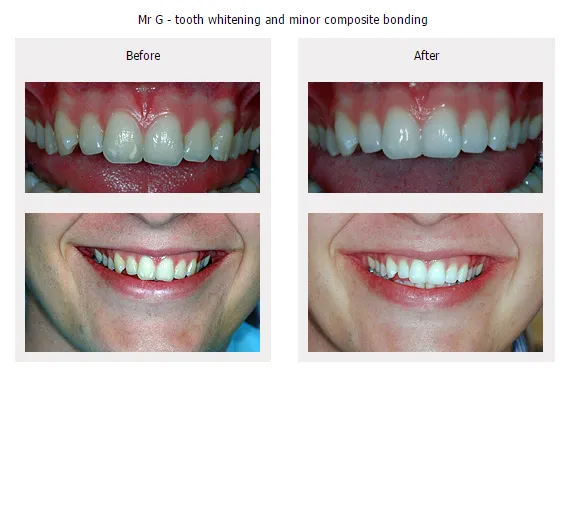 34617 tooth whitening oxford smiling