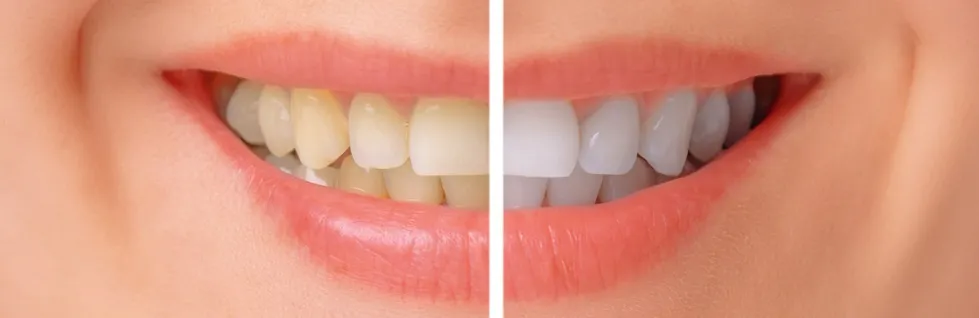 34618 before after pura teeth whitening