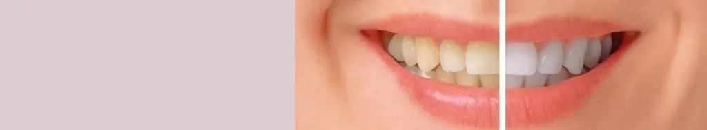 34618 pura teeth whitening aftercare