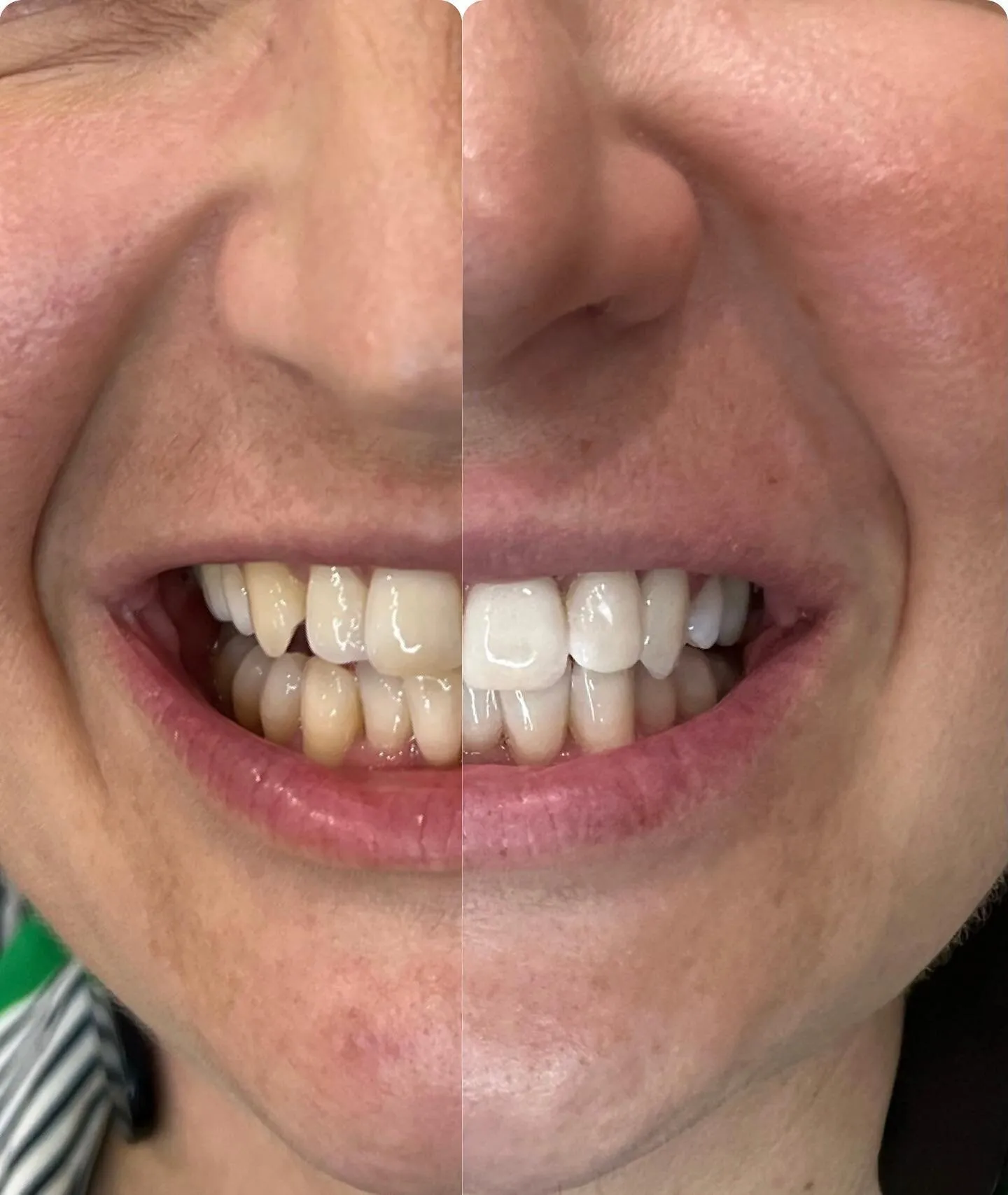 34640 boutique teeth whitening before after 1