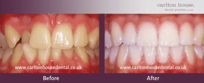 34640 boutique teeth whitening before after 3