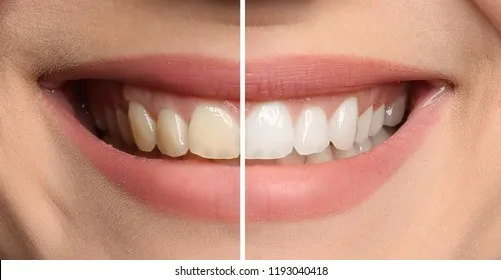 34640 boutique teeth whitening before after 4