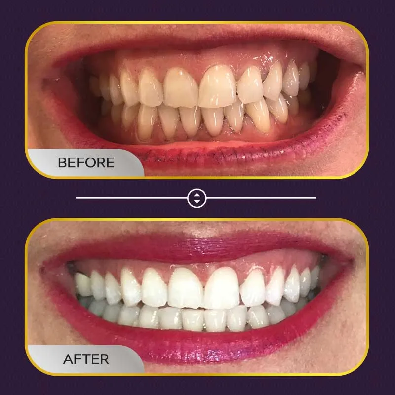 34640 boutique teeth whitening before after 5