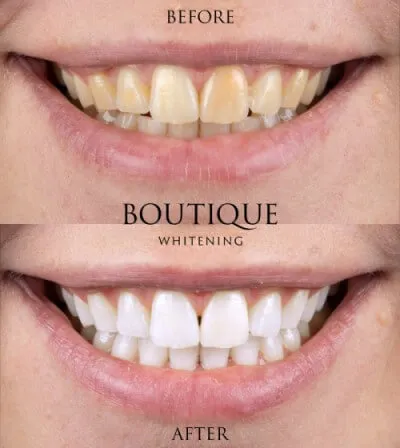 34640 boutique teeth whitening before after 6