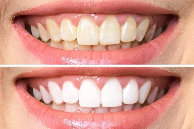 34640 boutique teeth whitening before after 7