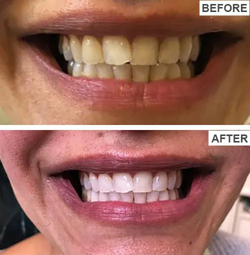 /img/34640-boutique-teeth-whitening-before-after-8.webp