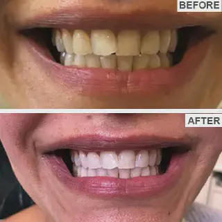 /img/34640-boutique-teeth-whitening-before-after-8.webp