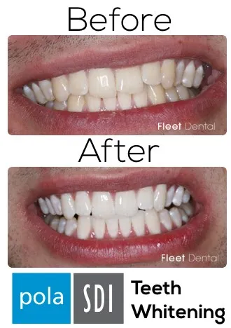 34642 teeth whitening hampshire at home kit