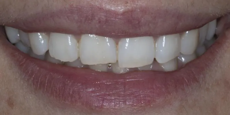 34642 teeth whitening hampshire dietary habits