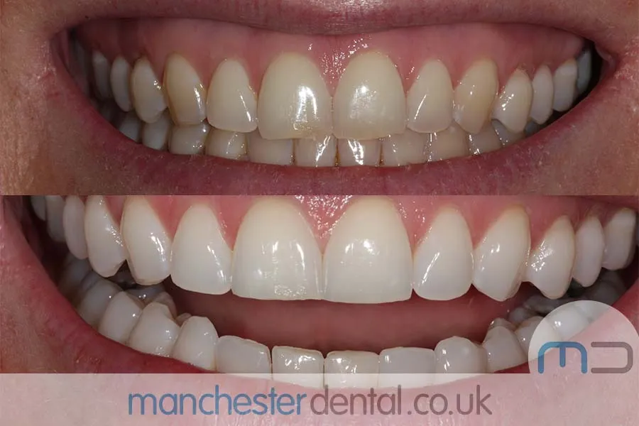 34642 teeth whitening hampshire maintenance tips