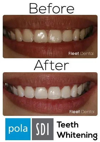 34642 teeth whitening hampshire oral health assessment