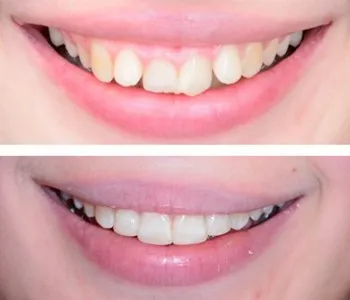 34658 teeth whitening glasgow home kits