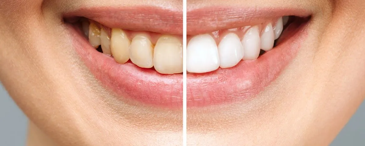 34661 whitening toothpaste irritation