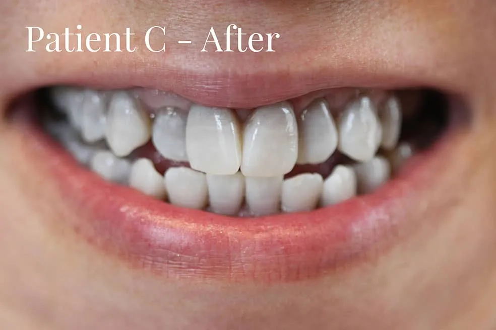 34689 kor whitening burning gums 5