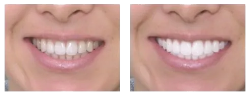 34696 teeth whitening options summit county