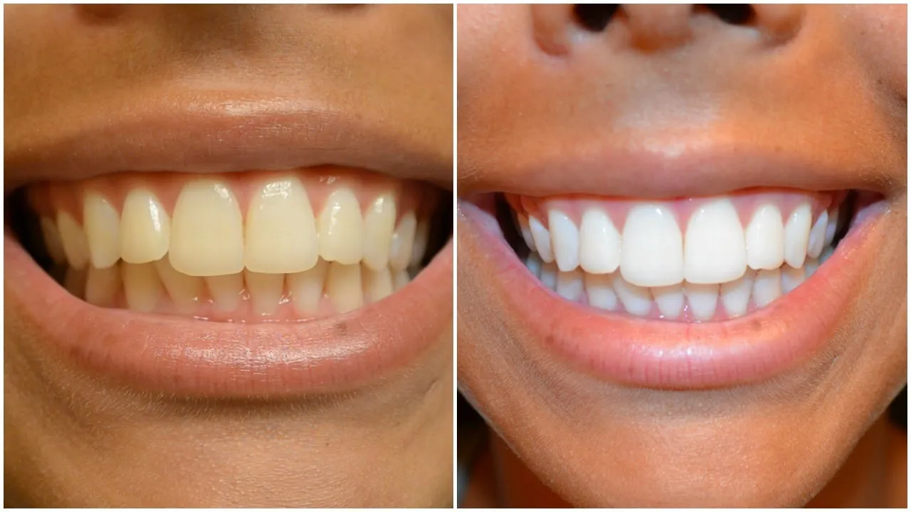 34715 whitening strips types
