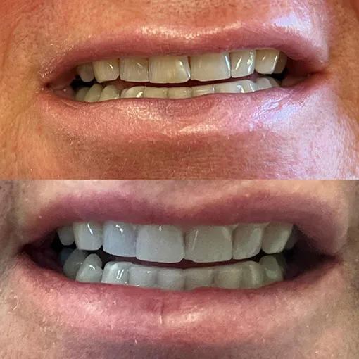 34740 teeth whitening touch up