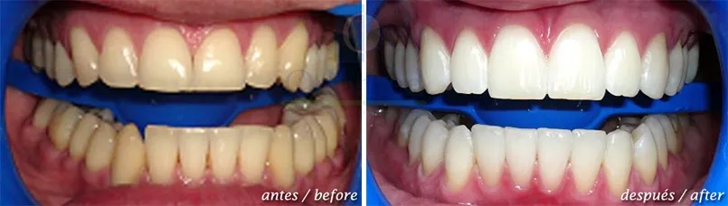 34747 costa rica teeth whitening before after