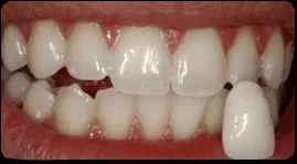 34747 costa rica teeth whitening clinic