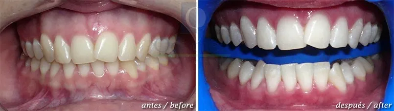 34747 costa rica teeth whitening dentist