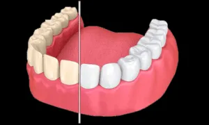 34747 costa rica teeth whitening procedure