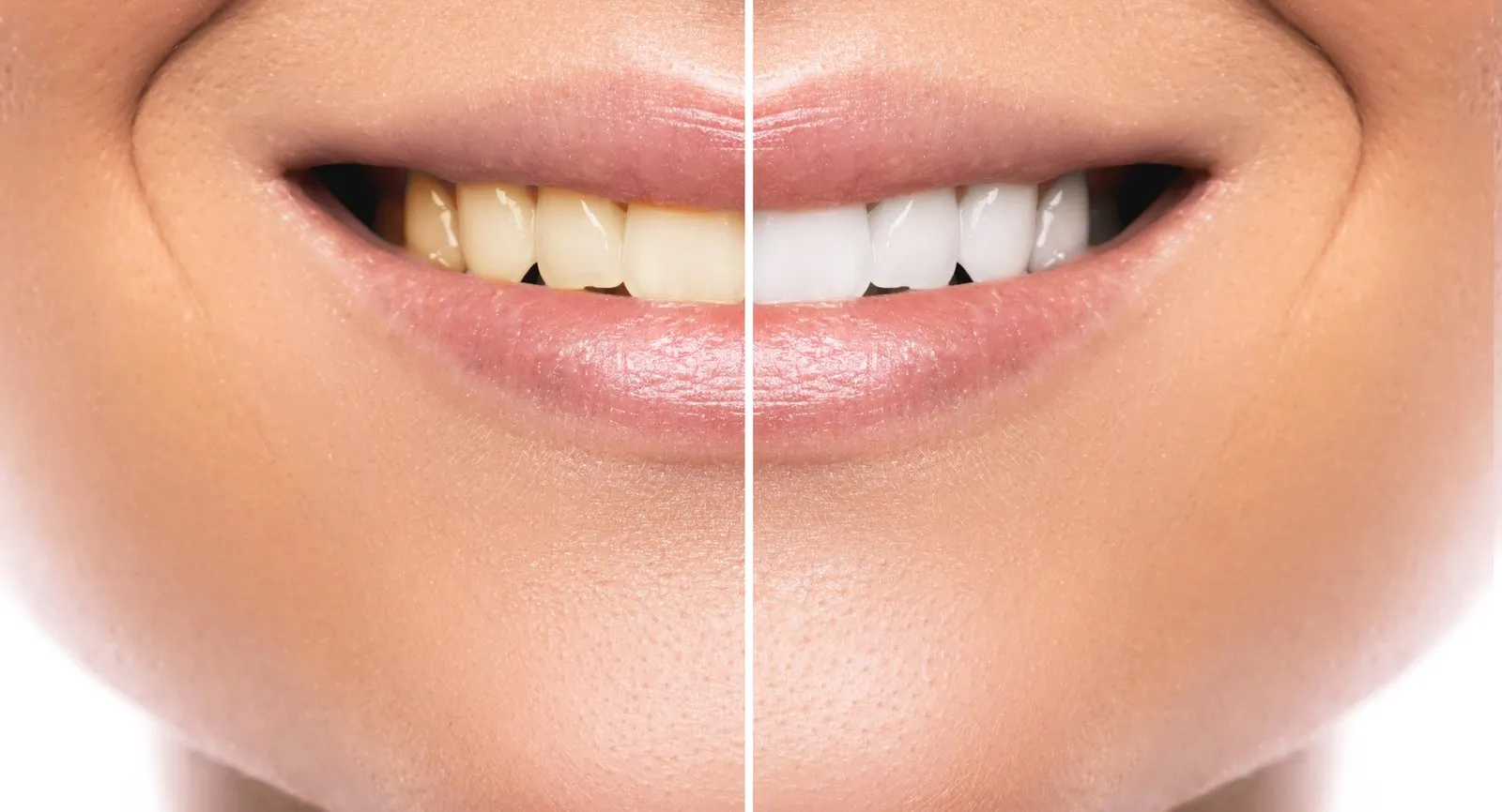 34747 costa rica teeth whitening results