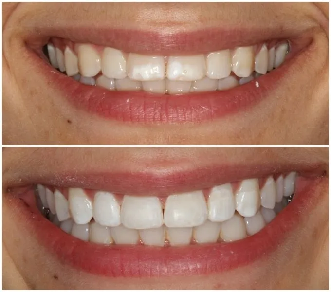 34782 columbia sc teeth whitening aftercare