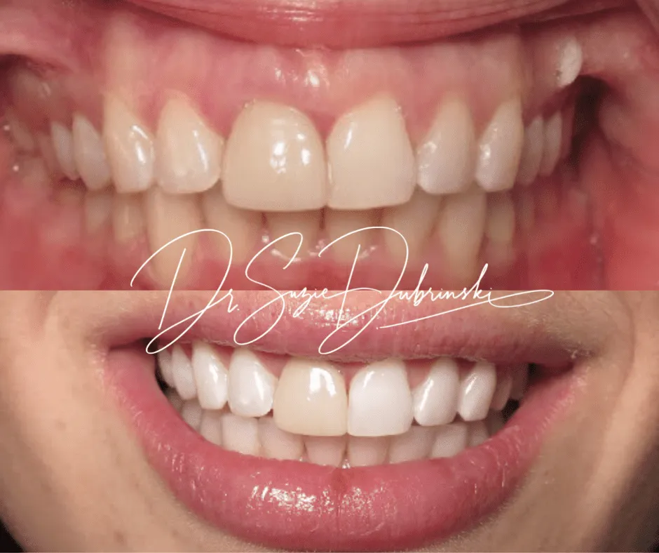 /img/34782-finding-teeth-whitening-dentist.webp