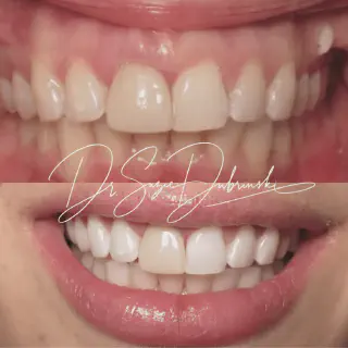 /img/34782-finding-teeth-whitening-dentist.webp