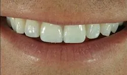 34782 take home teeth whitening kits