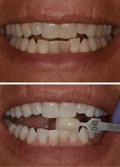 34782 teeth whitening causes discoloration